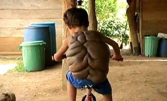 惊悚！哥伦比亚男孩患先天疾病 背上长“乌龟壳”