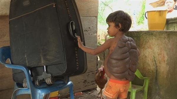 惊悚！哥伦比亚男孩患先天疾病 背上长“乌龟壳”