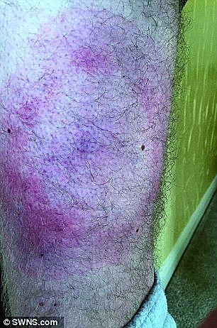 男子对苹果手机过敏：用iPhone 6悲剧了