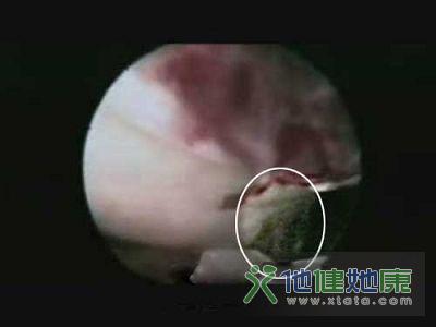 内窥镜揭秘女性排卵真实过程(图)