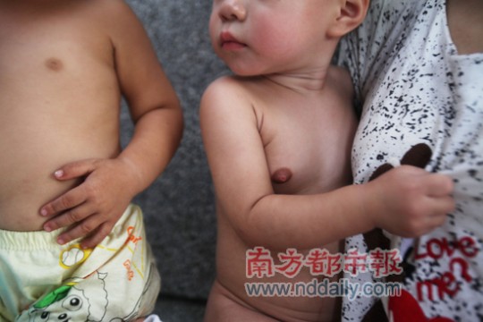 广州宝宝性早熟一岁半女婴乳房发育如同少女-+