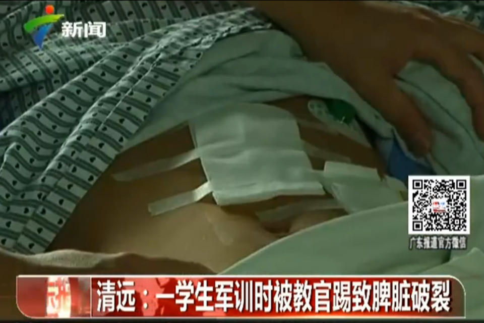 清远男孩军训被教官踢了一脚致脾脏破裂