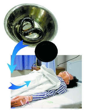  男子 阵发性 腹痛 从中 取出黄鳝  医生:或从肛门进