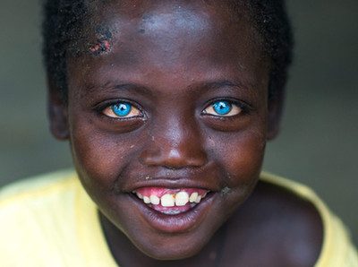 非洲男孩患罕见病症 天生蓝眼睛似混血
