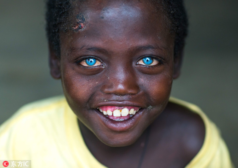 非洲男孩患罕见病症 天生蓝眼睛似混血图片