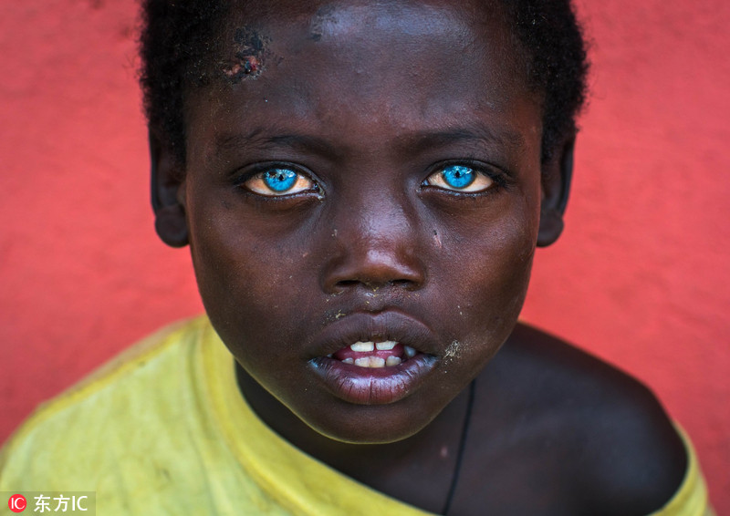 非洲男孩患罕见病症天生蓝眼睛似混血
