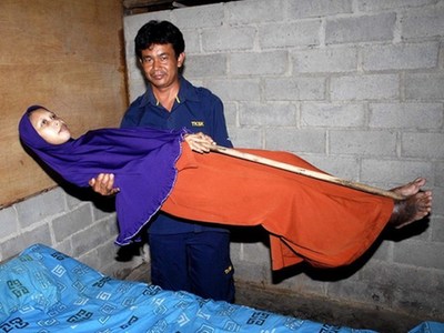 印尼女子患强直性脊柱炎25年成