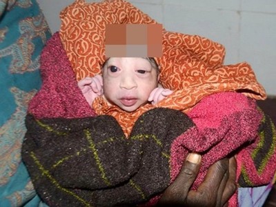印度女婴头长巨瘤皮肤如鳞 遭母嫌弃拒喂奶