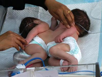 巴勒斯坦一医院连体婴儿出生 姐妹俩面对面