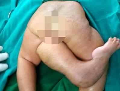 印度女婴通过手术成功切除“第三条腿”