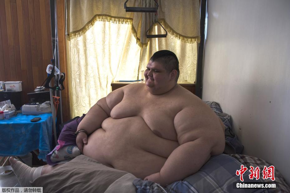 墨西哥男子体重曾达半吨 4个月治疗减去170公斤