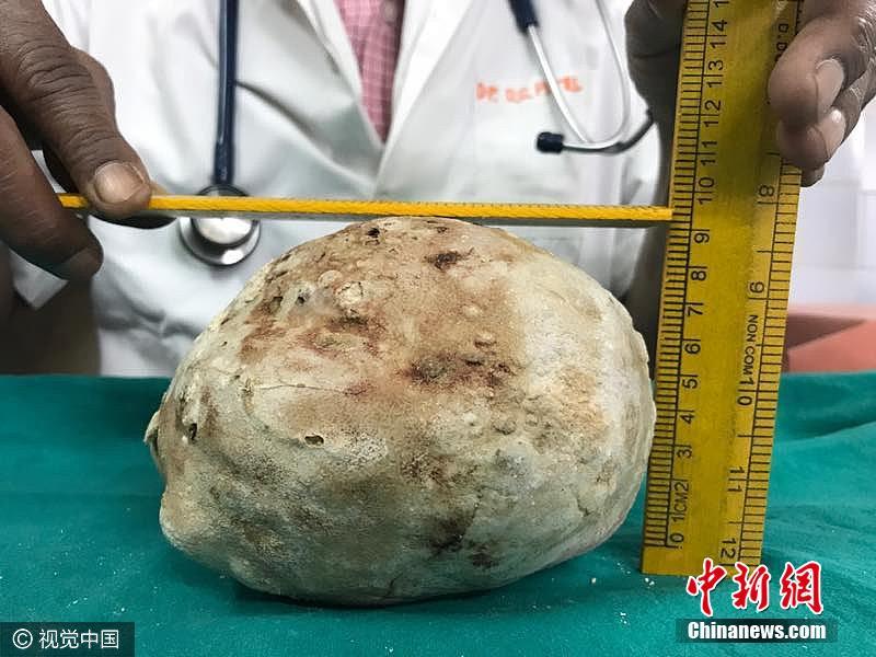 印度男子腹痛入院 膀胱取出1.5公斤巨型结石