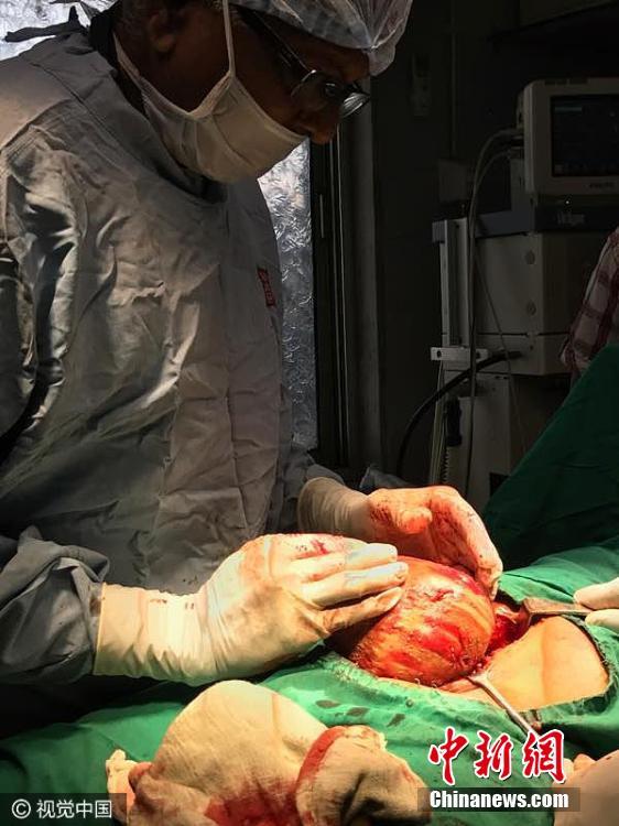 印度男子腹痛入院 膀胱取出1.5公斤巨型结石