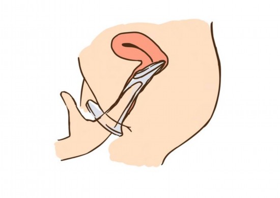 详细图解女式避孕套使用方法(组图)