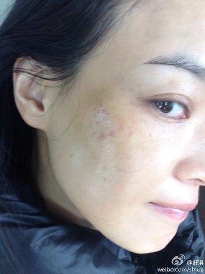 舒淇晒淤青自拍