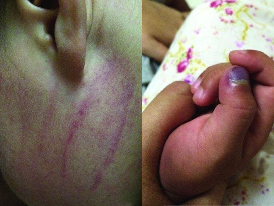 深圳2岁半宝宝生病吵闹 被保姆打紫脸夹肿手