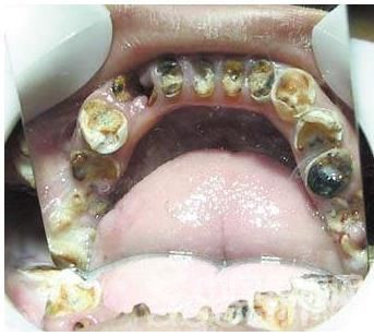 小明与丈夫生的婴儿牙齿是什么颜色的?